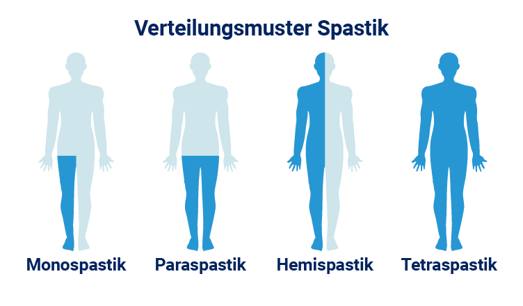 Was ist Spastik? Ursachen, Symptome & Behandlung