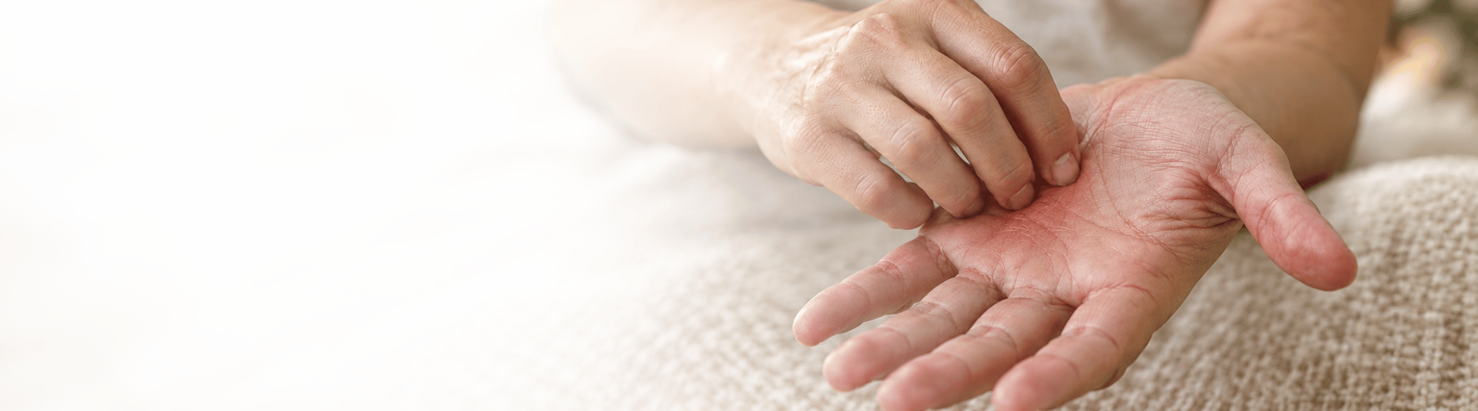 Nahaufnahme einer Person, die sich aufgrund von Juckreiz an der Handinnenfläche kratzt – ein mögliches Symptom der primär biliären Cholangitis (PBC).