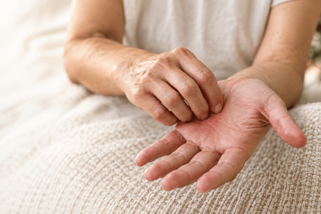 Nahaufnahme einer Person, die sich aufgrund von Juckreiz an der Handinnenfläche kratzt – ein mögliches Symptom der primär biliären Cholangitis (PBC).