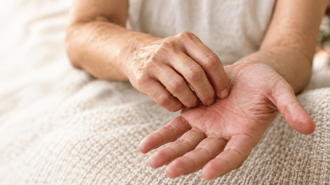 Nahaufnahme einer Person, die sich aufgrund von Juckreiz an der Handinnenfläche kratzt – ein mögliches Symptom der primär biliären Cholangitis (PBC).